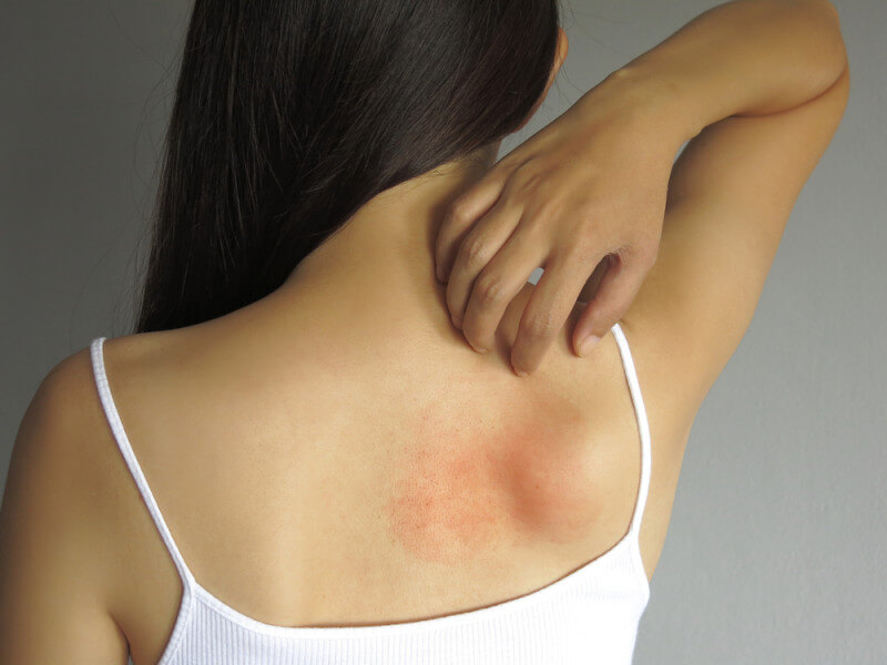 La urticaria es una de las manifestaciones más comunes de la alergia